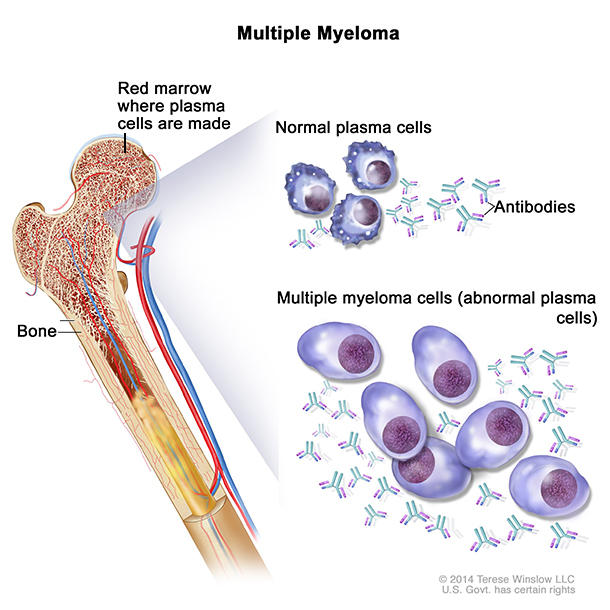 Multiple myeloma drawing shows normal plasma cells, multiple myeloma cells (abnormal plasma cells), and antibodies. Also shown is red marrow inside bone, where plasma cells are made. 