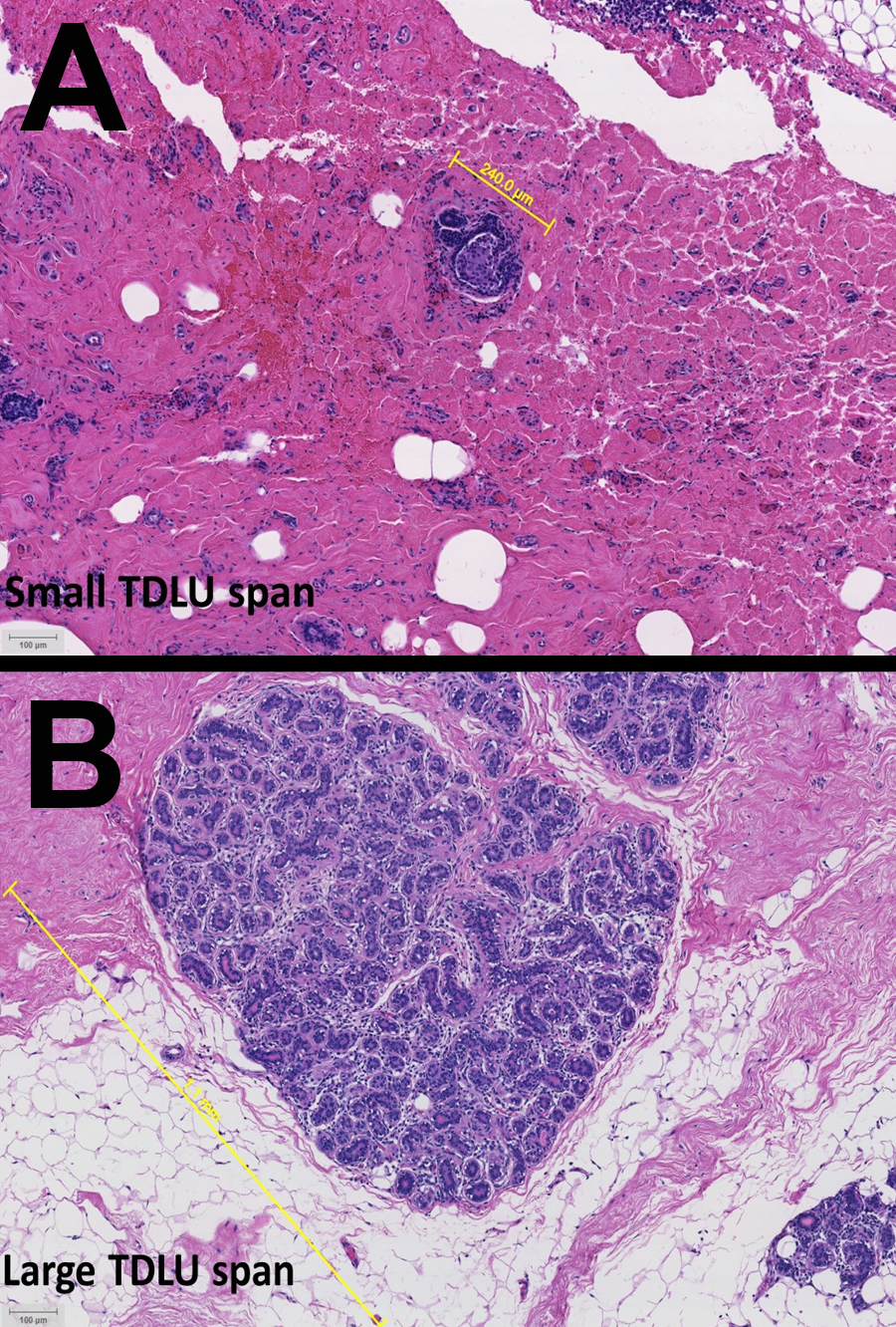 H&E images from patients with (A) luminal A and (B) triple negative breast cancer.  In the images above, the normal tissue adjacent to a triple negative tumor (B) shows a larger TDLU, and therefore reduced involution, compared to the smaller TDLU in normal tissue adjacent to a luminal A tumor (A).