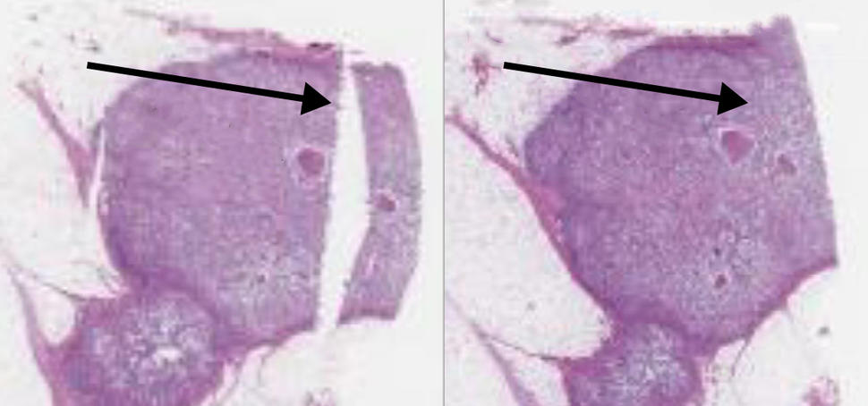 Before and after slides of stained slide of breast tumor tissue showing the repair of a tear in the original sample.