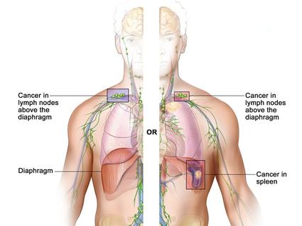 Stage III adult lymphoma; drawing shows the right and left sides of the body. The right side of the body shows cancer in a group of lymph nodes above the diaphragm and below the diaphragm. The left side of the body shows cancer in a group of lymph nodes above the diaphragm and cancer in the spleen.