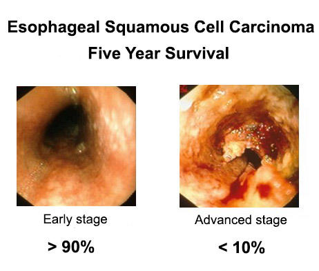 A two-panel image titled “Esophageal Squamous Cell Carcinoma Five Year Survival.” On the left, an esophagus without any deformity has a caption below that reads “Early Stage >90%.” On the right, an esophagus with bleeding and growths has a caption below that reads “Advanced stage <10%”.