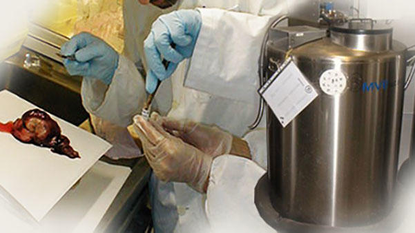 Pathologist examines lung tissue immediately following surgical resection, prior to freezing with liquid nitrogen.