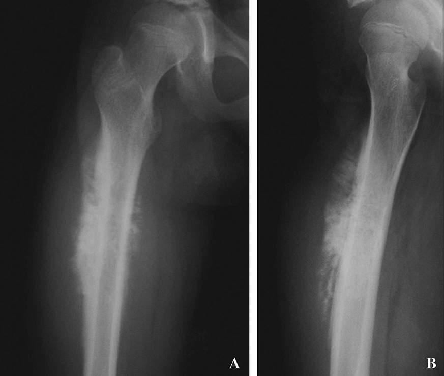 An x-ray of a femur from a patient with osteosarcoma