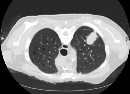 Image of a computed tomography scan of the lungs.