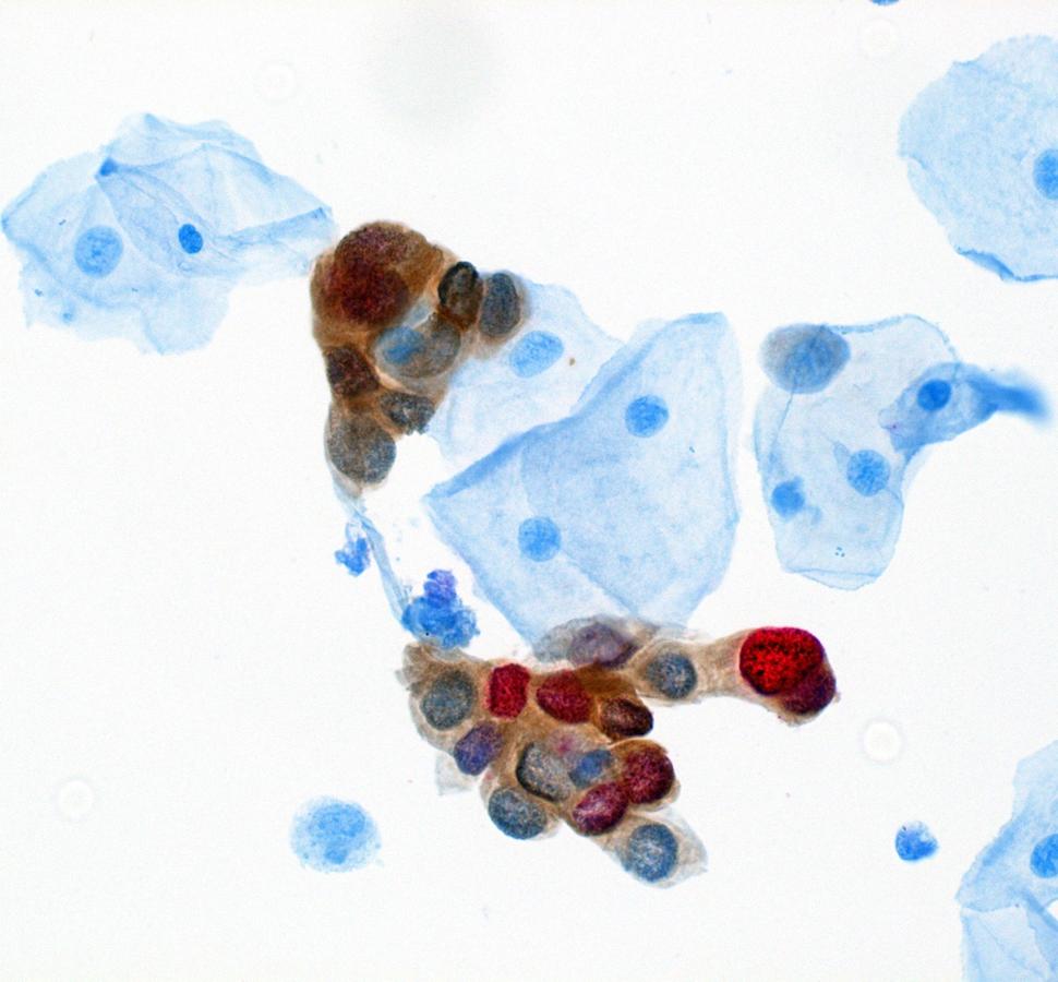 HPV dual stain test sample