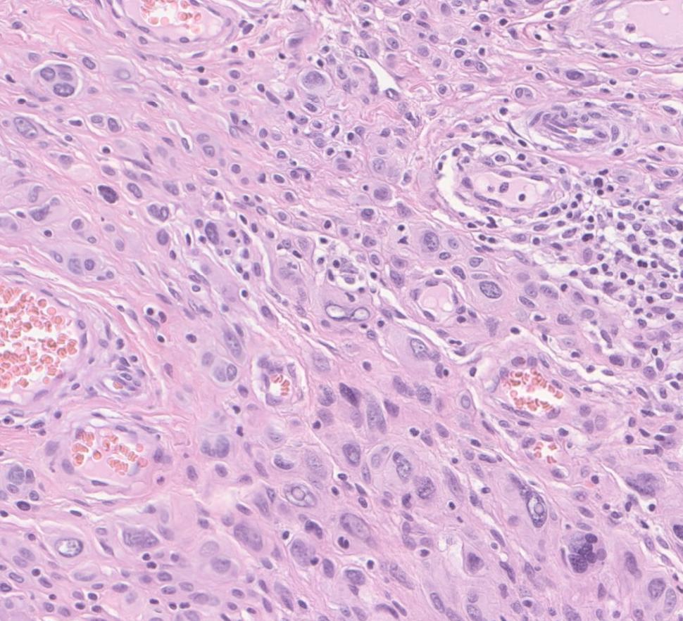 Photo of atypical spitzoid melanoma tissue under a microscope
