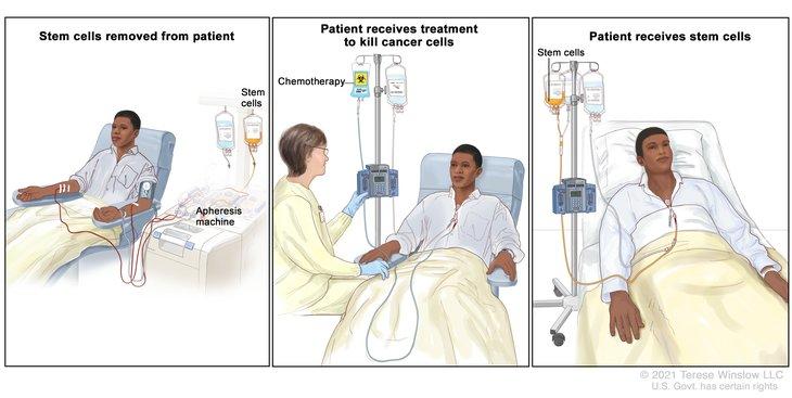 3 sets of illustrations showing the process of Autologous stem cell transplant: stem cells removed from a patient, patient receiving treatment to kill cancer cells and a patient receiving stem cells