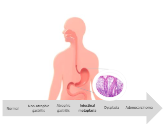 Cartoon showing stomach and GI tract with text explaining the progression from normal stomach to cancer