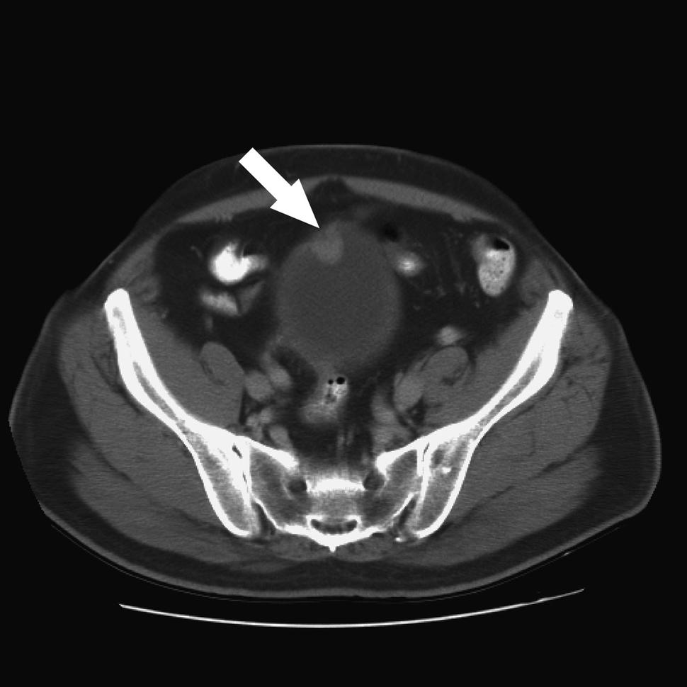 Computed tomography (CT) scan of the bladder showing bladder cancer (arrow).