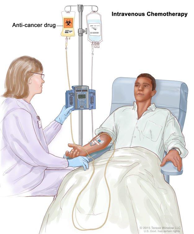 Intravenous (IV) chemotherapy. A patient is given an anti-cancer drug through a vein in the arm. The anti-cancer drug travels through the blood to kill cancer cells in the body.