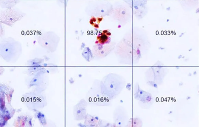 An image from a dual-stain test performed using Dr. Wentzensen’s AI program. It shows the likelihood that cervical cells are cancerous or pre-cancerous. 