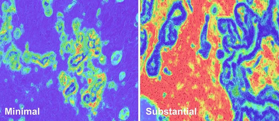 tissue samples showing minimal and substantial stromal disruption in the breast