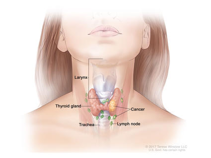 Anatomical drawing of thyroid, lymph node, trachea, larynx, and cancer on the thyroid and lymph node.