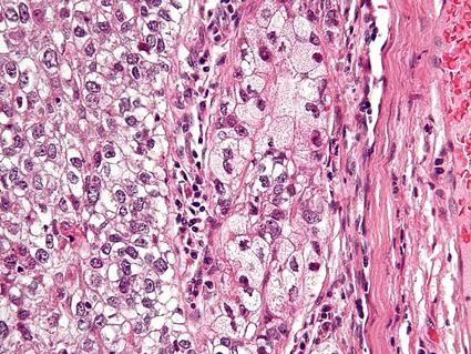 Very high magnification micrograph of a sebaceous tumor with H&E stain (pink and purple).