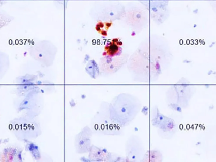 An image from a dual-stain test performed using Dr. Wentzensen’s AI program. It shows the likelihood that cervical cells are cancerous or pre-cancerous. 