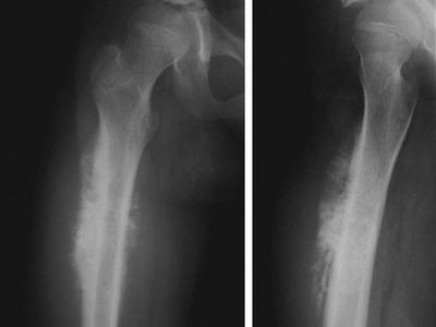 An x-ray of a femur from a patient with osteosarcoma