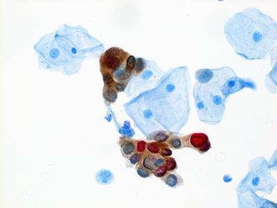 HPV dual stain test sample