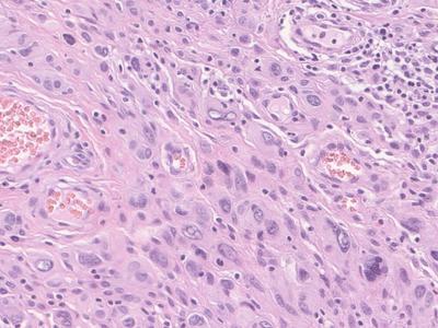 Photo of atypical spitzoid melanoma tissue under a microscope