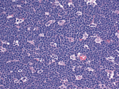 magnified image of Burkitt lymphoma 