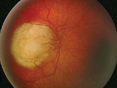 medical image showing retinoblastoma
