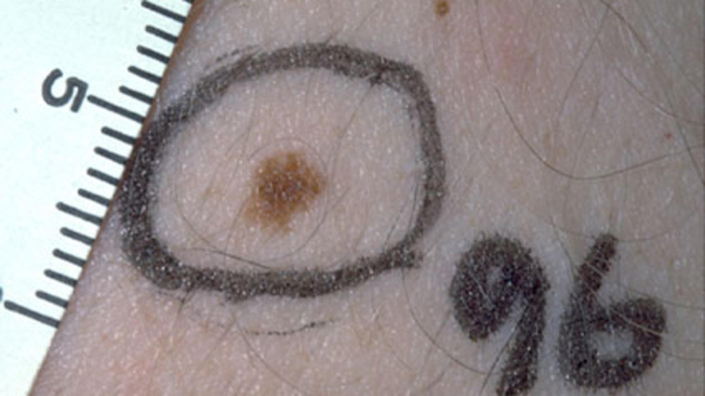 mole on a light skinned person circled in black marker and next to a ruler