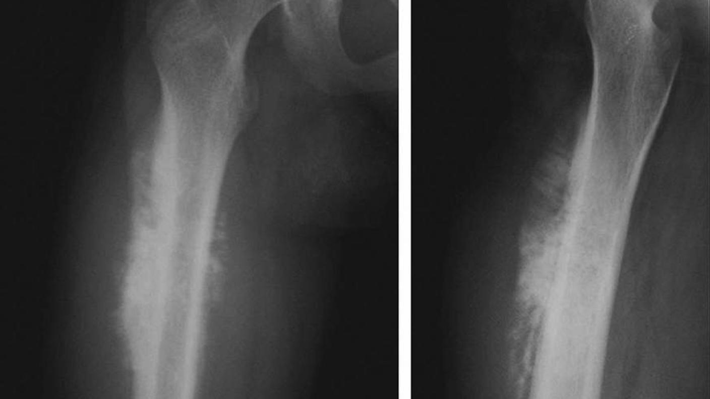 An x-ray of a femur from a patient with osteosarcoma