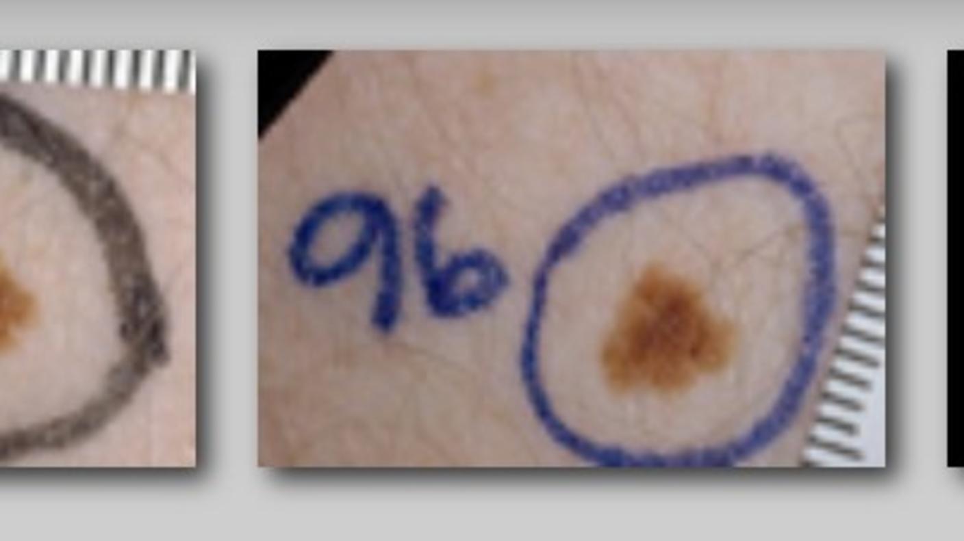 Series of 5 images depicting changes of a dysplastic nevus over time.