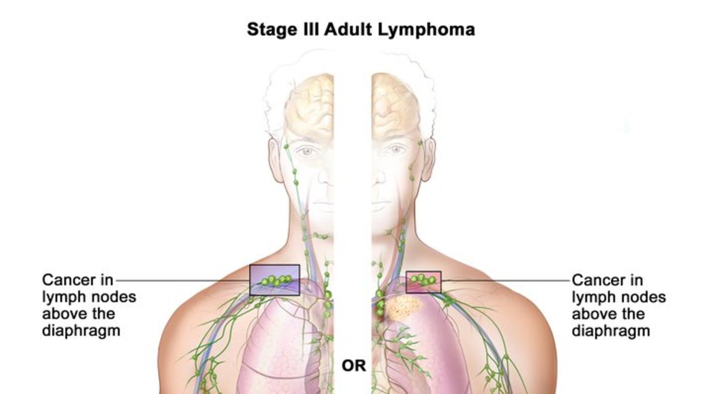 Stage III adult lymphoma; drawing shows the right and left sides of the body. The right side of the body shows cancer in a group of lymph nodes above the diaphragm and below the diaphragm. The left side of the body shows cancer in a group of lymph nodes above the diaphragm and cancer in the spleen.