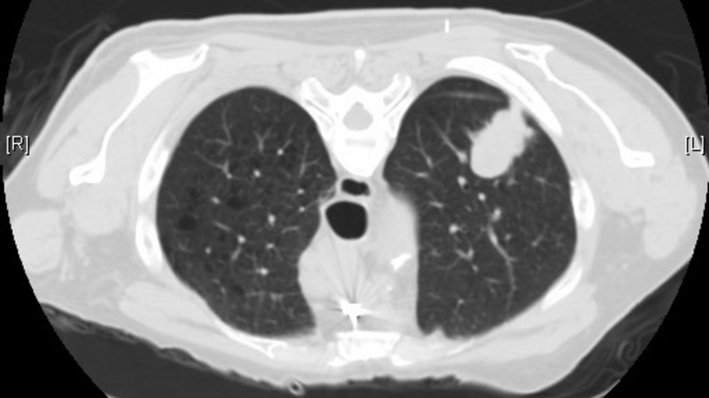 Image of a computed tomography scan of the lungs.