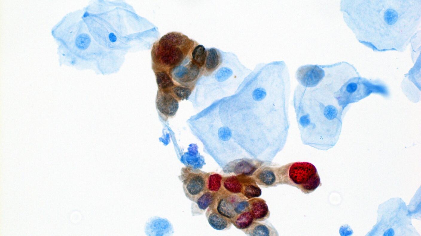 HPV dual stain test sample