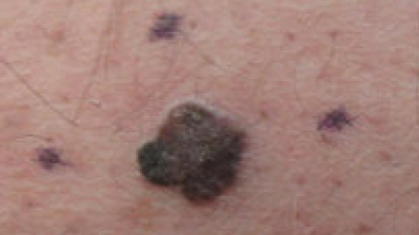 Dark brown spot on fair skin with four markings around it.
