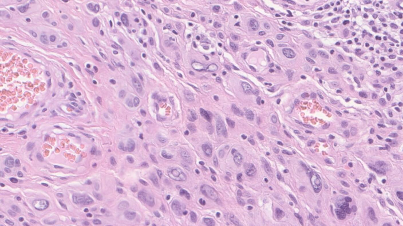 Photo of atypical spitzoid melanoma tissue under a microscope