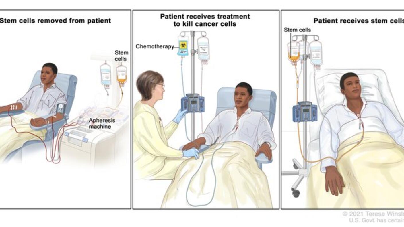 3 sets of illustrations showing the process of Autologous stem cell transplant: stem cells removed from a patient, patient receiving treatment to kill cancer cells and a patient receiving stem cells