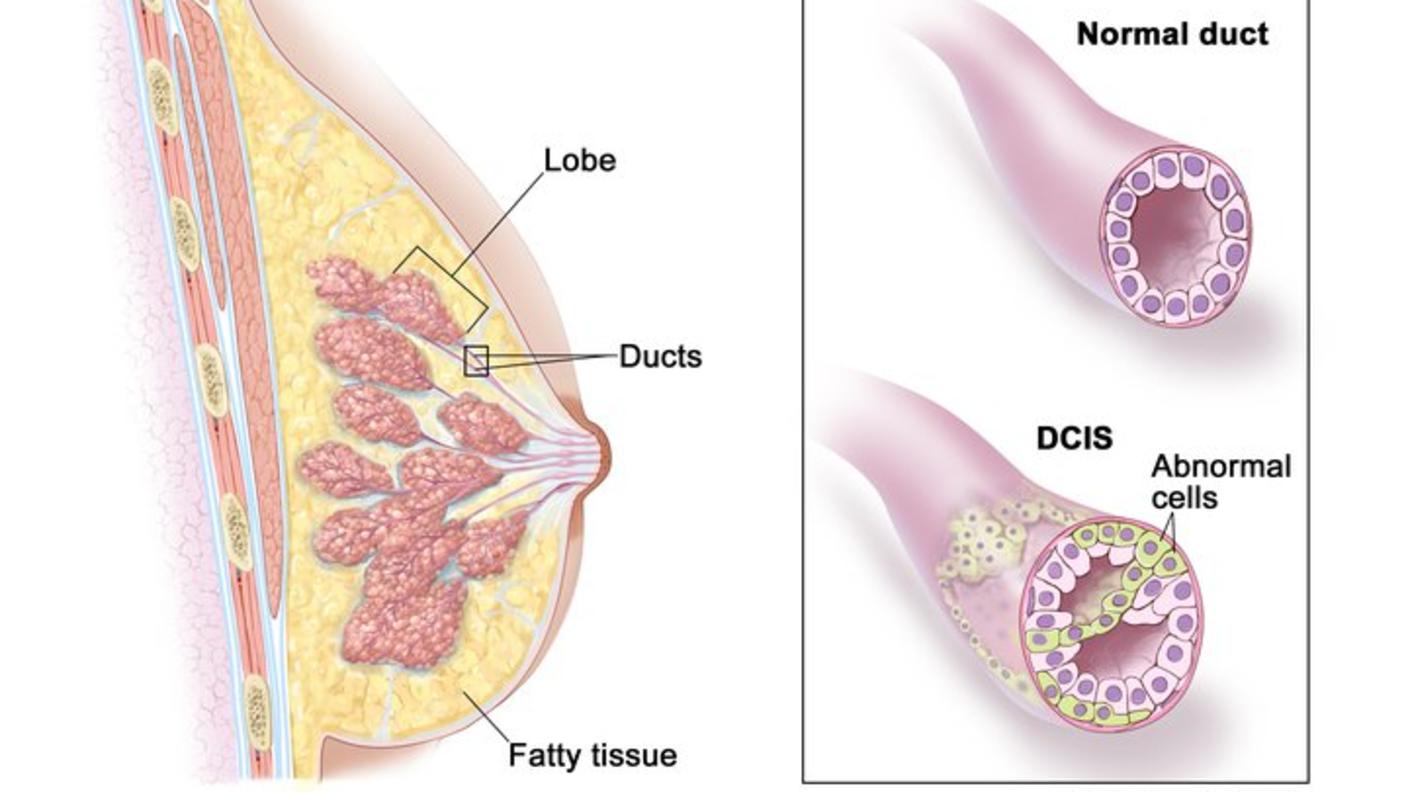  Ductal carcinoma in situ (DCIS); drawing shows a lobe, ducts, and fatty tissue in a cross section of the breast. The inset shows a normal duct and an example of DCIS with abnormal cells in the lining of the breast duct. 