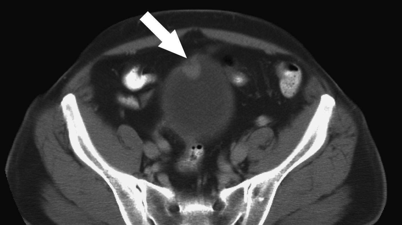 Computed tomography (CT) scan of the bladder showing bladder cancer (arrow).