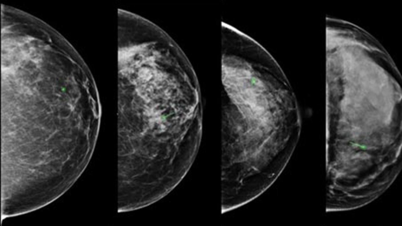 mammograms showing breast density