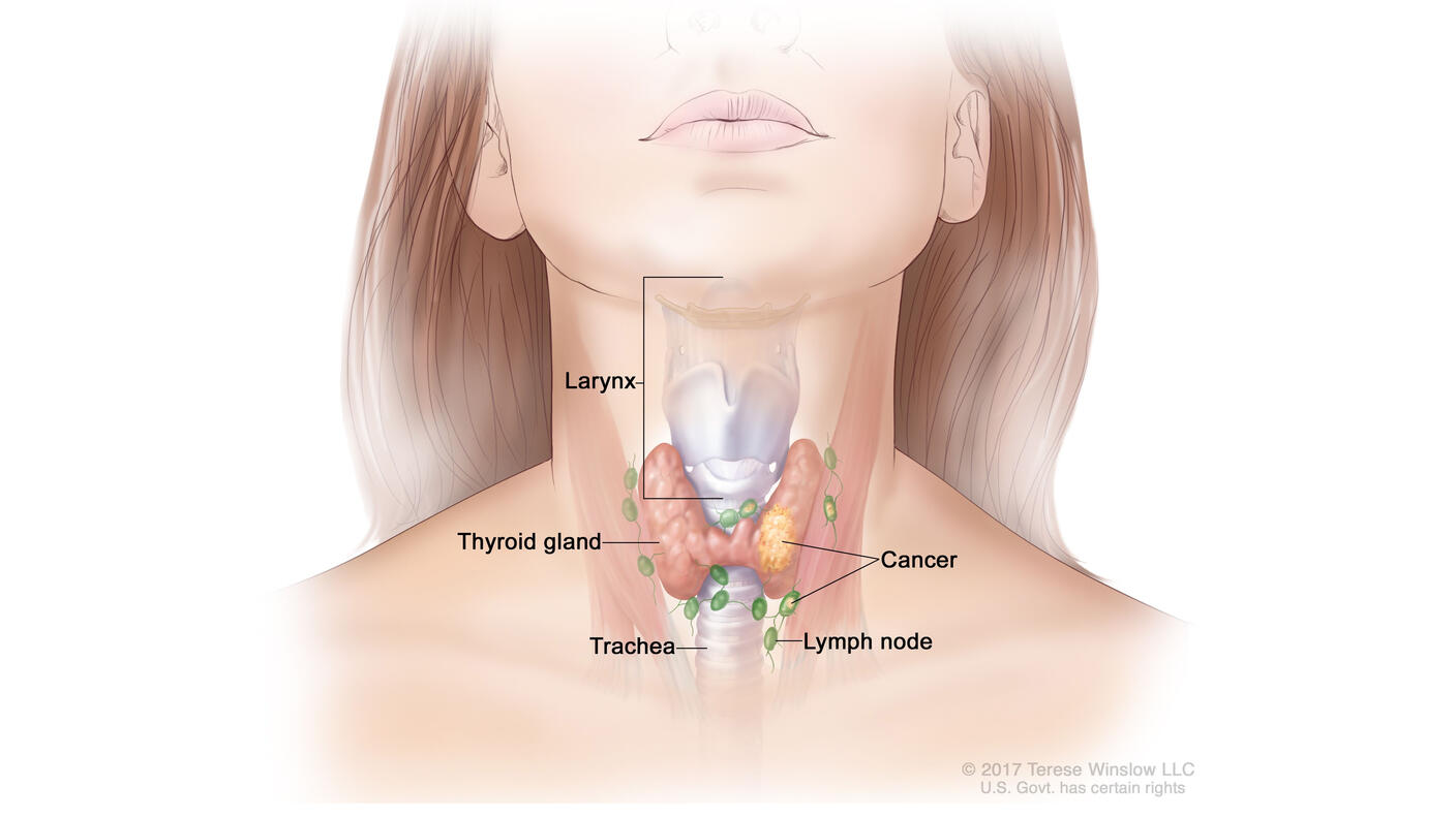 Anatomical drawing of thyroid, lymph node, trachea, larynx, and cancer on the thyroid and lymph node.