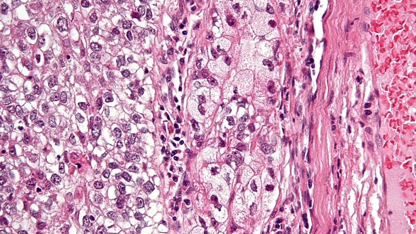 Very high magnification micrograph of a sebaceous tumor with H&E stain (pink and purple).