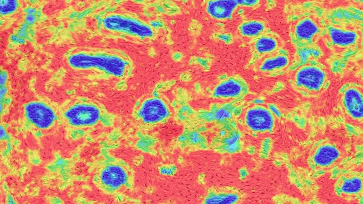 tissue samples showing stromal disruption in the breast