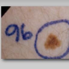 Series of 5 images depicting changes of a dysplastic nevus over time.