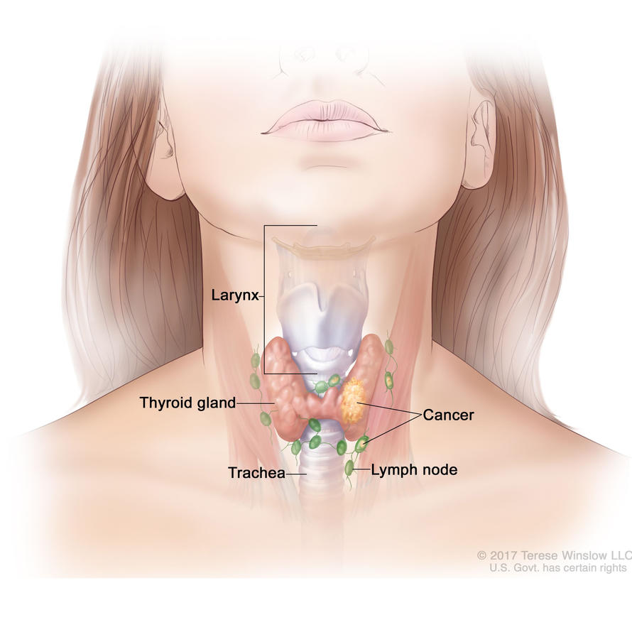 Anatomical drawing of thyroid, lymph node, trachea, larynx, and cancer on the thyroid and lymph node.
