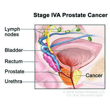 Stage IVA prostate cancer; drawing shows cancer in one side of the prostate and in nearby lymph nodes. The PSA can be any level and the Grade Group is 1 ,2, 3, 4, or 5. Also shown are the bladder, rectum, and urethra.