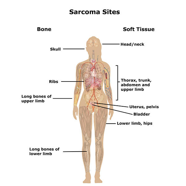 Anatomical diagram showing male and female anatomy labeled with sites where bone and soft tissue sarcoma may arise. Bone sarcoma sites include: skull, ribs, and long bones of upper limb and lower limb. Soft tissue sarcoma sites include: head/neck, thorax, trunk, abdomen, upper limb, uterus, pelvis, bladder, lower limb and hips.