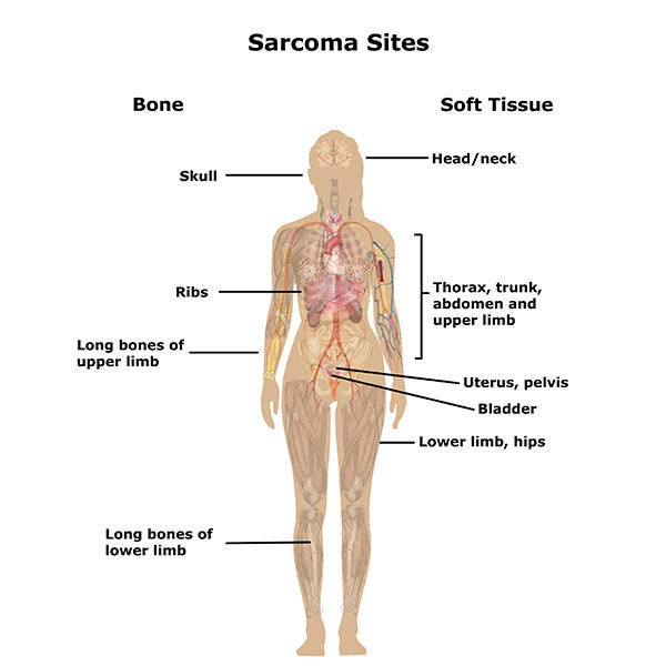 Sarcoma cancer what is it