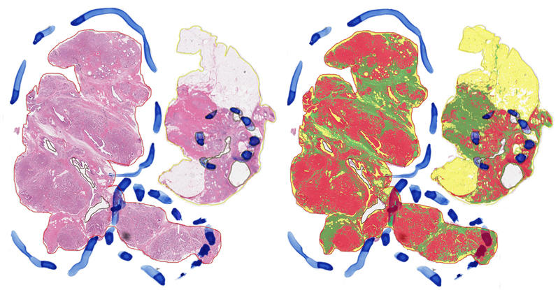 A set of before and after images displaying the same tumor sample in its H&E stain (before) and after digital analysis to detect epithelial, stromal, and adipose tissue components.