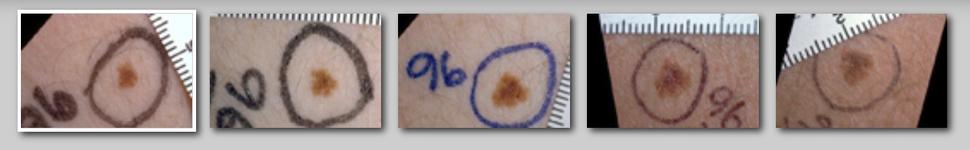Series of 5 images depicting changes of a dysplastic nevus over time.