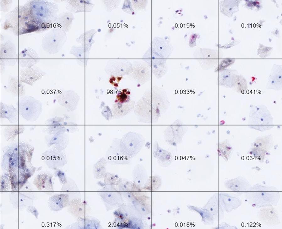 A slide from an automated dual-stain cytology test. 