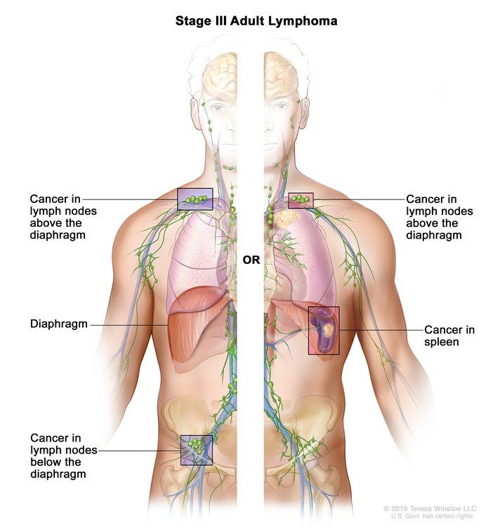 Stage III adult lymphoma; drawing shows the right and left sides of the body. The right side of the body shows cancer in a group of lymph nodes above the diaphragm and below the diaphragm. The left side of the body shows cancer in a group of lymph nodes above the diaphragm and cancer in the spleen.