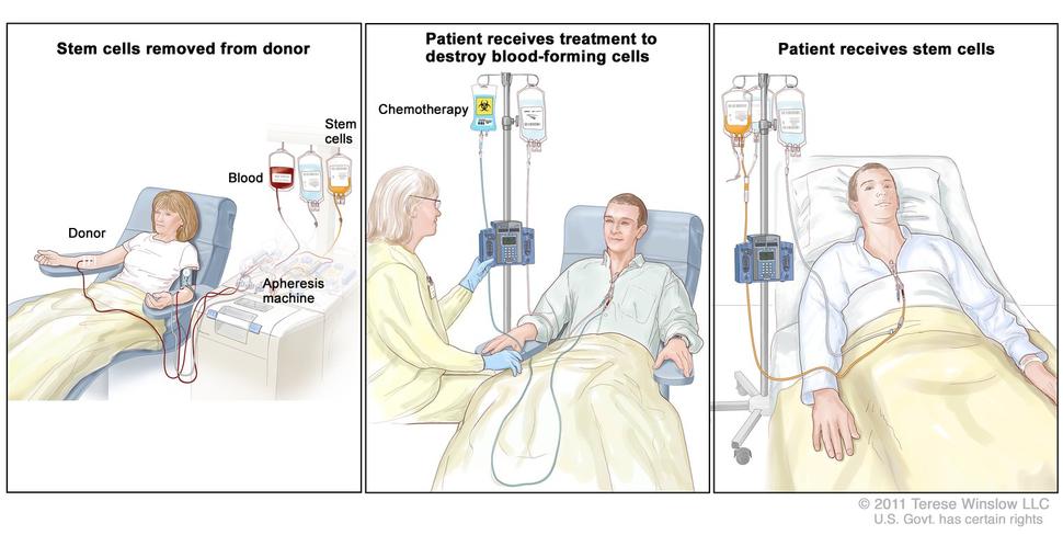 illustration in three panels of a hematopoietic stem cell transplant. Panel 1: Stem cells removed from donor. Panel 2: Patient receives treatment to destroy blood-forming cells (chemotherapy). Panel 3: Patient receives stem cells.