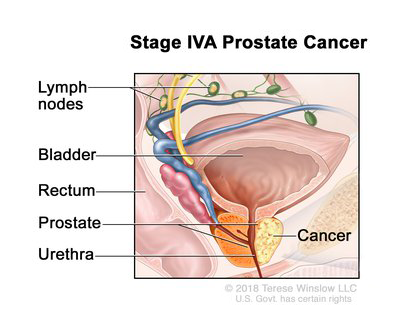 Stage IVA prostate cancer; drawing shows cancer in one side of the prostate and in nearby lymph nodes. The PSA can be any level and the Grade Group is 1 ,2, 3, 4, or 5. Also shown are the bladder, rectum, and urethra.